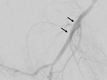 Stent implantation for erectile dysfunction stent against